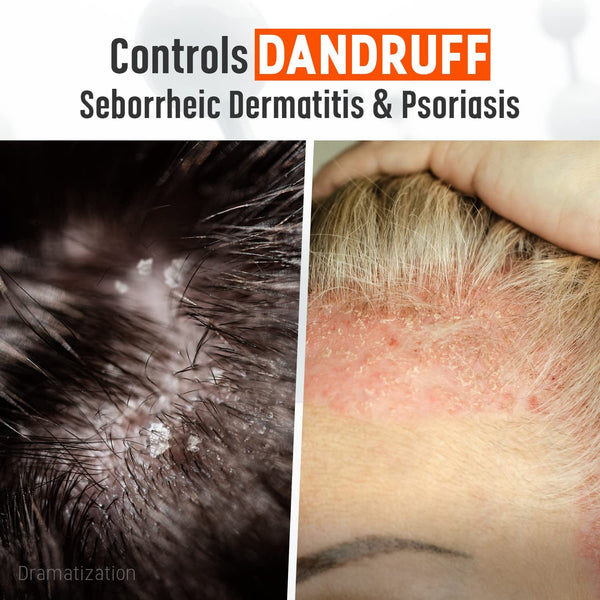 Medicasp Coal Tar Gel Dandruff Shampoo to Treat Seborrheic Dermatitis Psoriasis, 6 Ounce (Pack of 1)